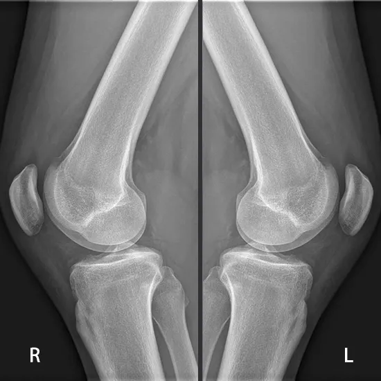 X-ray Both Knee LAT View